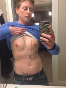 2/15/14; 45 days post-op, 5 days post-areola resizing